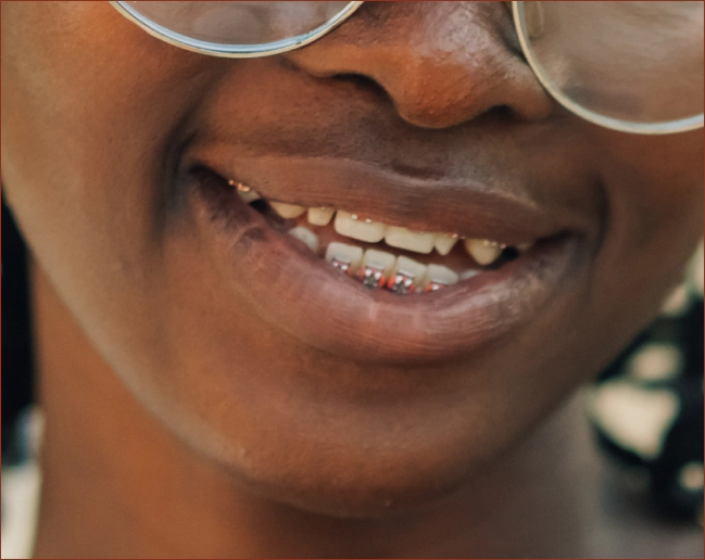 Crowding, Spacing and Impacted or Missing Teeth